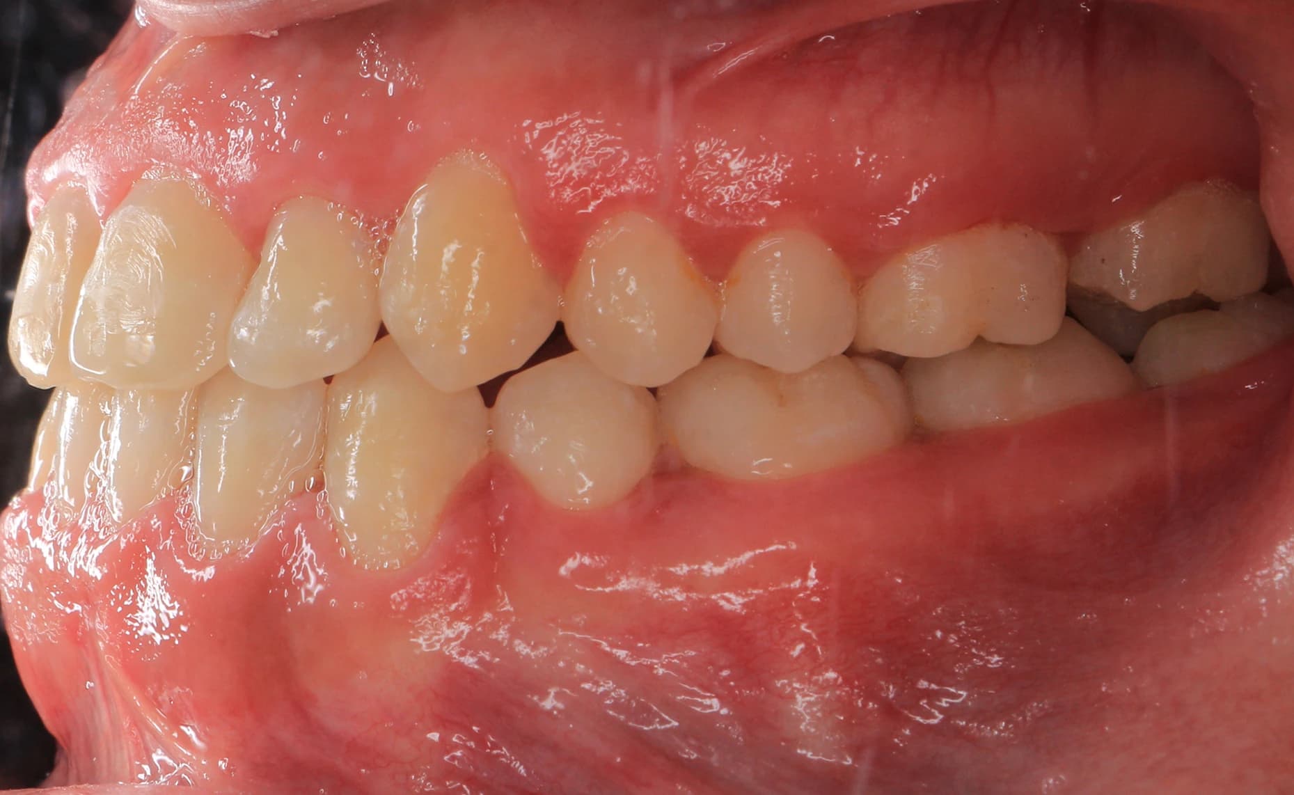 بعد - صورة قبل وبعد تركيب تركيبات الأسنان – تعويض مثالي للأسنان المفقودة بتركيبات ثابتة أو متحركة في توث ميت، أفضل عيادة أسنان في المعادي، احجز معنا لعلاج مخصص