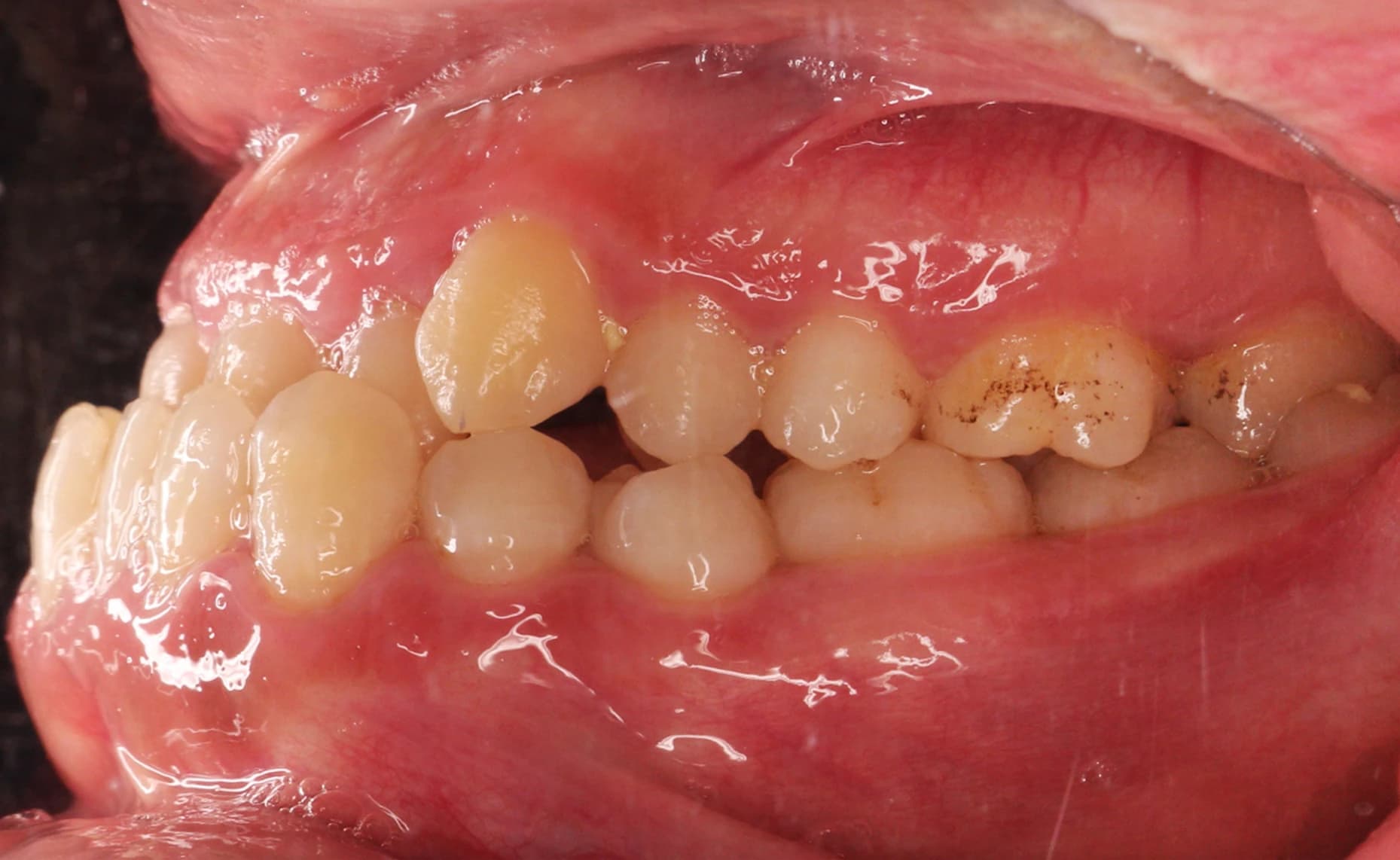 قبل - صورة قبل وبعد تركيب تركيبات الأسنان – تعويض مثالي للأسنان المفقودة بتركيبات ثابتة أو متحركة في توث ميت، أفضل عيادة أسنان في المعادي، احجز معنا لعلاج مخصص