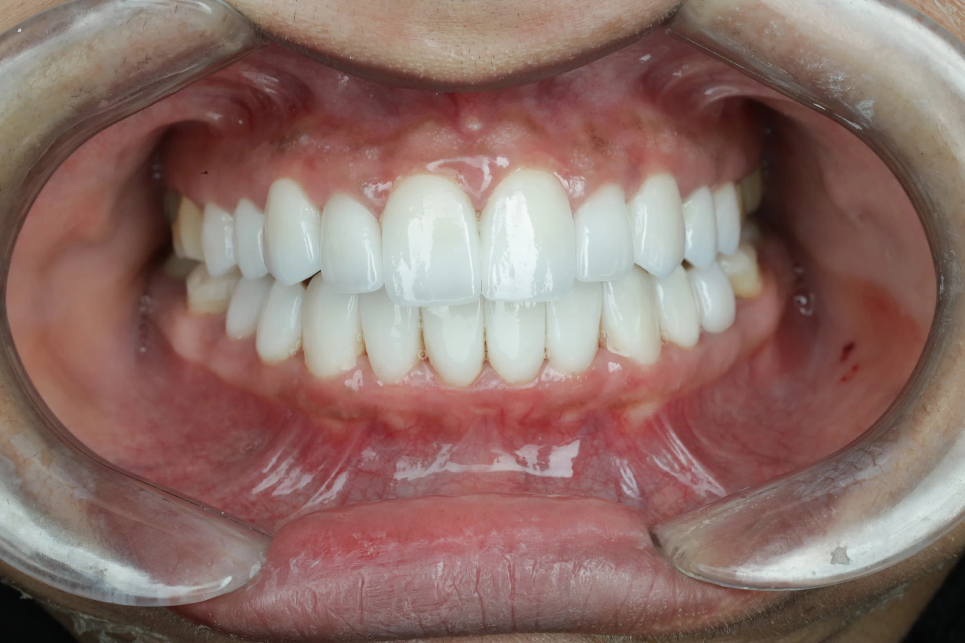 بعد - صورة قبل وبعد زراعة الأسنان – استعادة الأسنان المفقودة بمظهر طبيعي وثبات عالي في توث ميت، أفضل عيادة زراعة أسنان في المعادي، احجز الآن مع أفضل دكتور زراعة