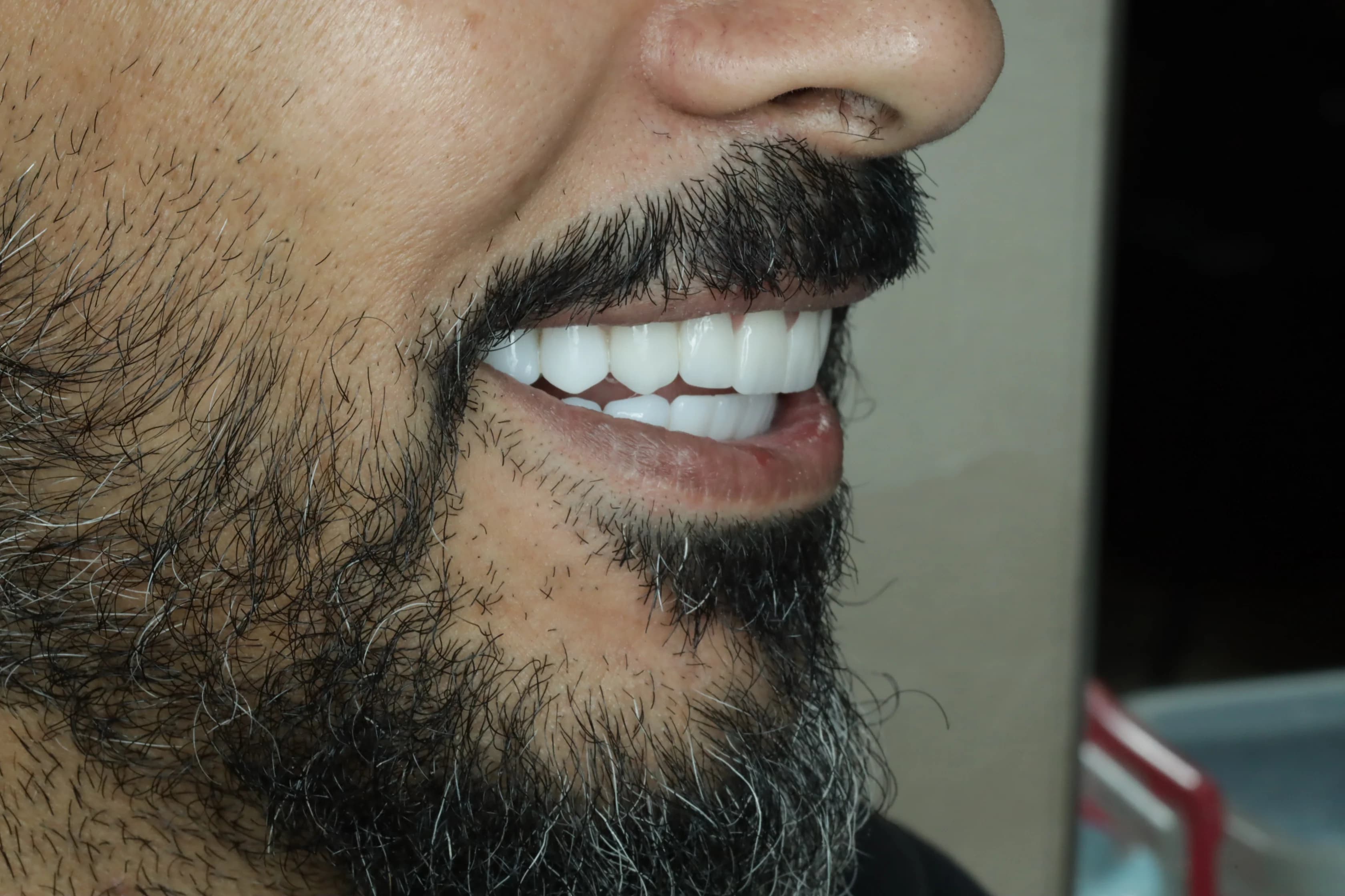 بعد - صورة قبل وبعد تركيب فينير الأسنان – تُبرز بياض الأسنان وتناسقها للحصول على ابتسامة هوليود جذابة في توث ميت، أفضل عيادة تجميل أسنان في المعادي، احجز الآن