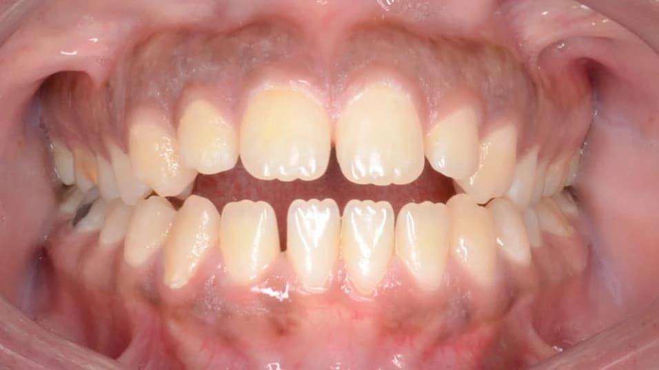 قبل - صورة قبل وبعد حشو الأسنان التجميلي – إصلاح التسوس وتحسين شكل السن باستخدام حشوات بلون طبيعي في توث ميت، أفضل عيادة أسنان في المعادي، احجز الآن مع أفضل دكتور تجميل