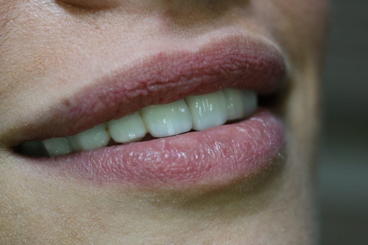 صورة توضح ابتسامة هوليود سمايل بعد تركيب الفينيرز