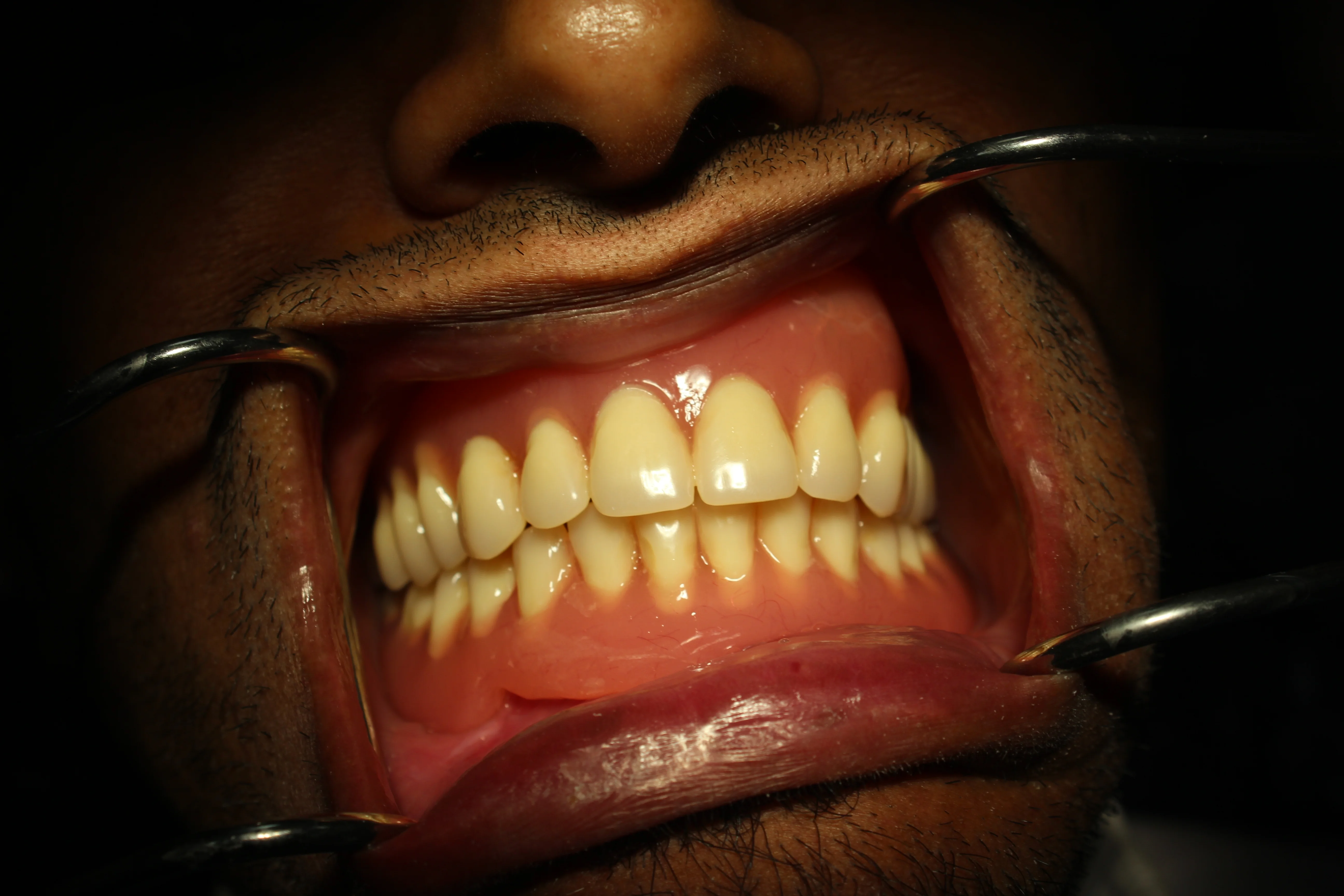 قبل وبعد زراعة الأسنان - استبدال الأسنان بمظهر طبيعي - بعد - حالة 1