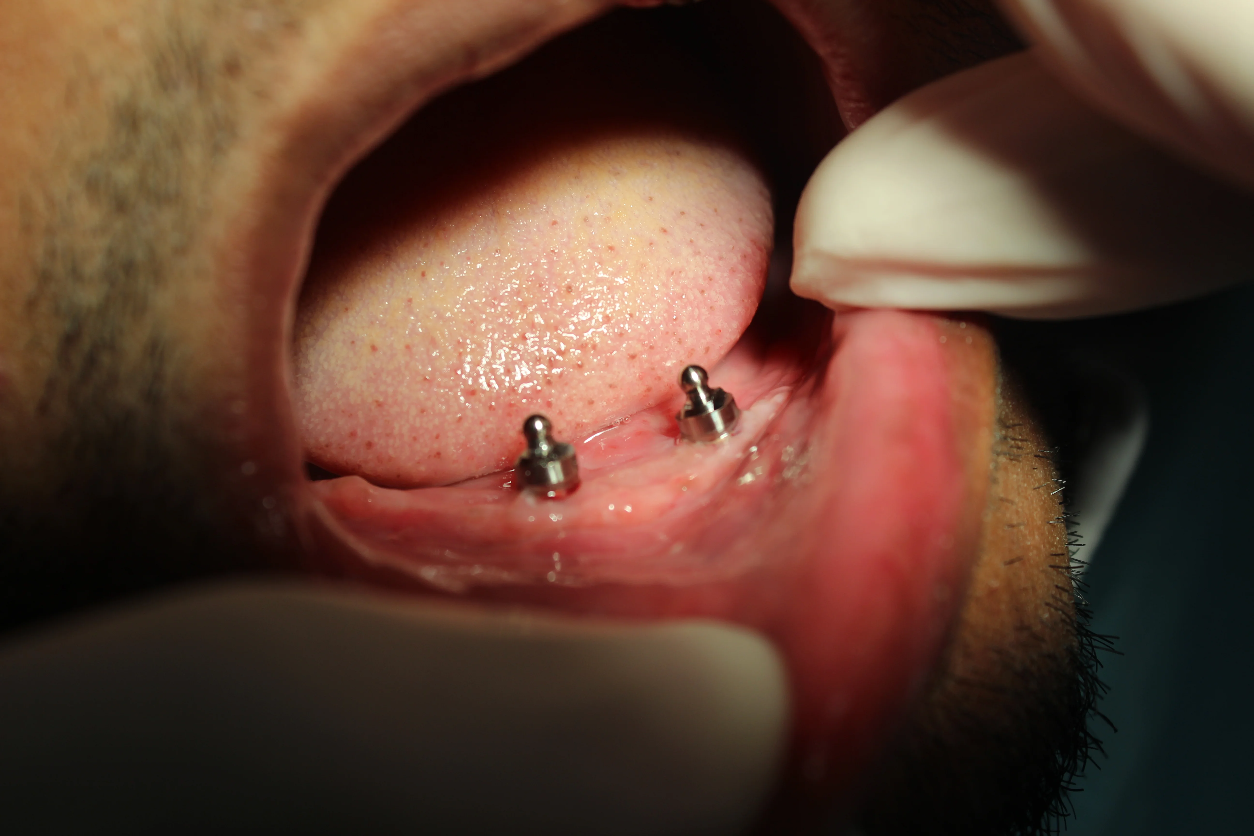 قبل وبعد زراعة الأسنان - استبدال الأسنان بمظهر طبيعي - قبل - حالة 1