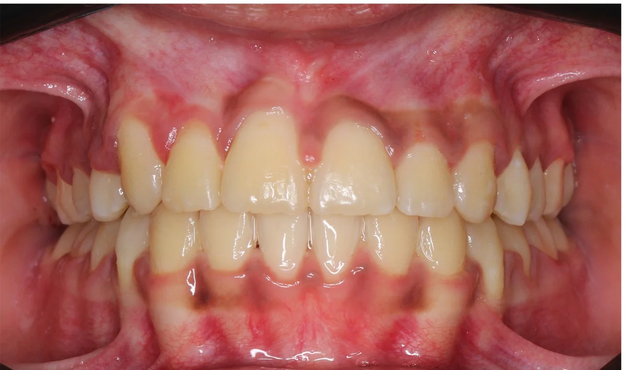 قبل وبعد تقويم الأسنان - نتائج محاذاة مثالية للأسنان - بعد - حالة 1