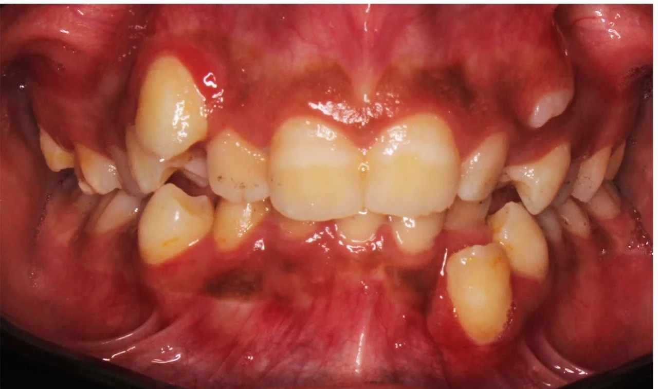 قبل وبعد تقويم الأسنان - نتائج محاذاة مثالية للأسنان - قبل - حالة 1