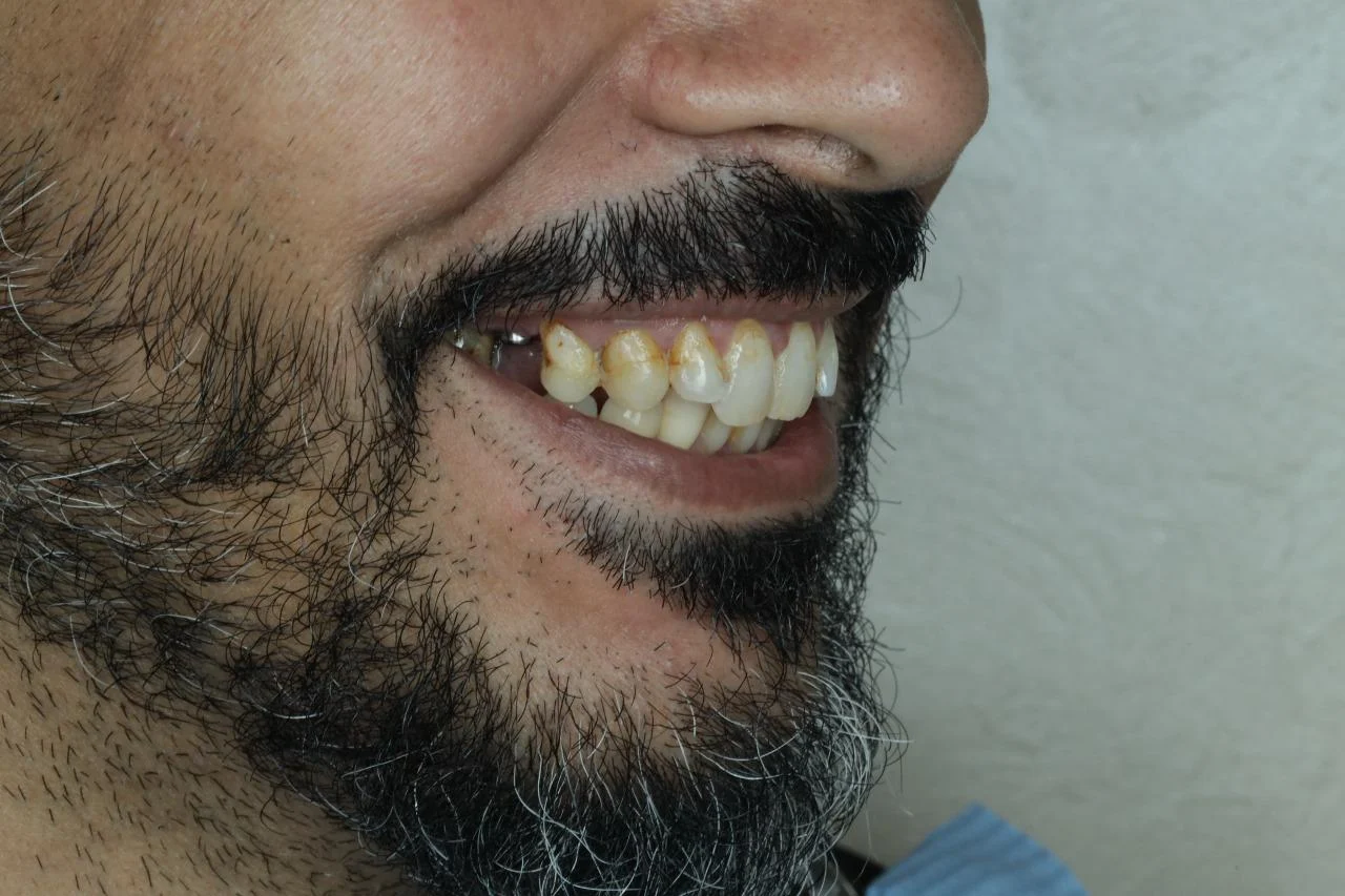 تحويل الابتسامة فينير الأسنان - تحسن كامل في مظهر الأسنان - قبل - حالة 1